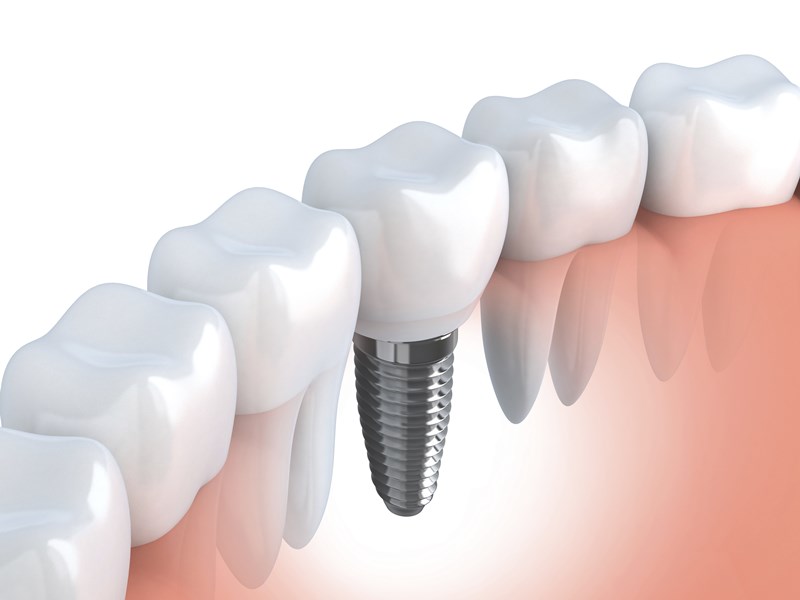 Dental implant