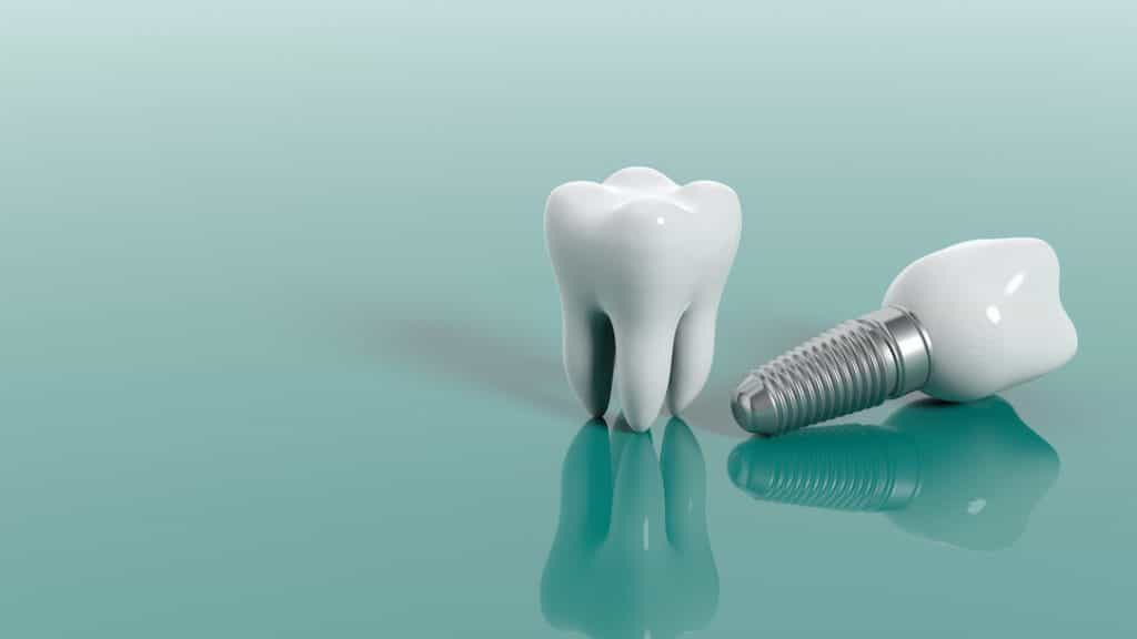 Importance Of Missing Teeth Replacement Singapore And Its Usage