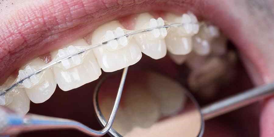What is Invisalign & Know All About Best Invisalign in Singapore?
