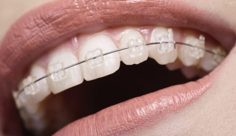 What is Invisalign & Know All About Best Invisalign in Singapore?